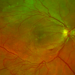 Διαβητική Ωχροπάθεια