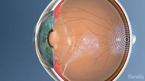 ενδουαλοειδική ένεση