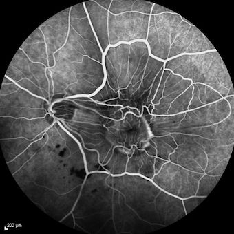 Εκφύλιση Ωχράς Κηλίδας