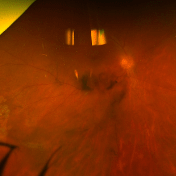 Μυγάκια στο μάτι