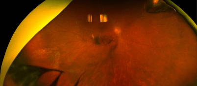 Μυγάκια στο μάτι