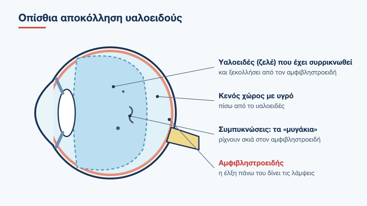 Τομή ματιού με οπίσθια αποκόλληση υαλοειδούς: το ζελέ έχει ξεκολλήσει από τον αμφιβληστροειδή