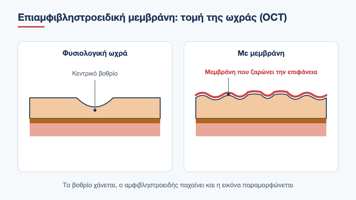 Σχηματική τομή OCT φυσιολογικής ωχράς δίπλα σε ωχρά με επιαμφιβληστροειδική μεμβράνη που ζαρώνει την επιφάνεια