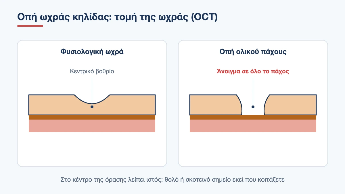 Σχηματική τομή OCT φυσιολογικής ωχράς δίπλα σε οπή ωχράς κηλίδας ολικού πάχους