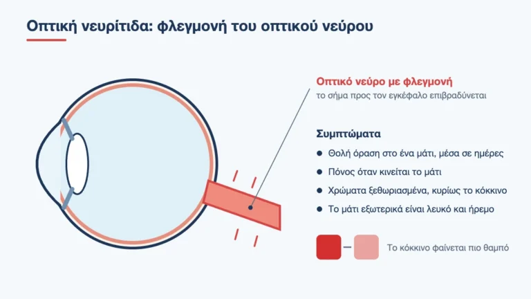 Τομή ματιού με φλεγμονή στο οπτικό νεύρο και τα συμπτώματα της οπτικής νευρίτιδας