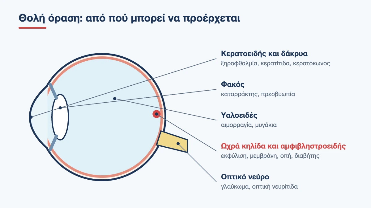 Τομή ματιού με τα σημεία όπου προκαλείται θολή όραση: κερατοειδής, φακός, υαλοειδές, ωχρά κηλίδα, οπτικό νεύρο
